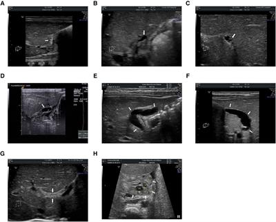 A nomogram model based on preoperative grey-scale US features and routine serum biomarkers to predict the outcome of infants with biliary atresia after Kasai portoenterostomy